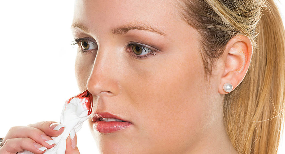 Qué es la epistaxis nasal
