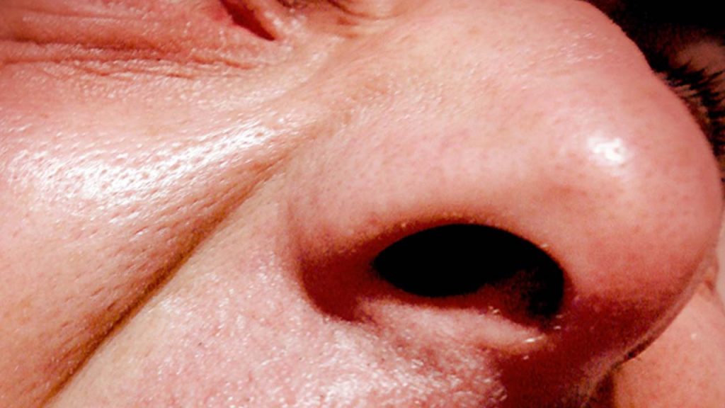 Cirugía de de la Nariz ¿Qué Debés Saber?